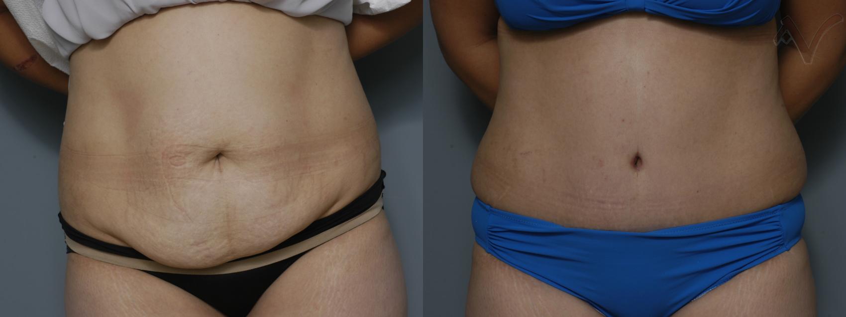 Before & After Tummy Tuck Case 211 Front View in Los Angeles, CA