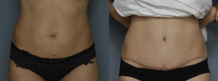 Before & After Tummy Tuck Case 214 Front View in Los Angeles, CA