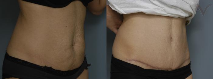 Before & After Tummy Tuck Case 214 Right Oblique View in Los Angeles, CA