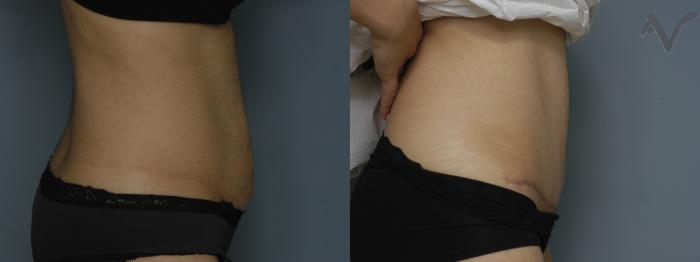 Before & After Tummy Tuck Case 214 Right Side View in Los Angeles, CA