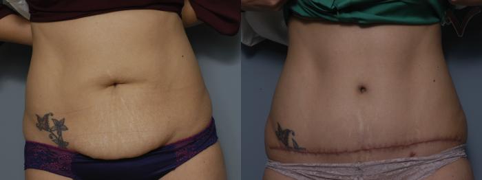 Before & After Tummy Tuck Case 215 Front View in Los Angeles, CA