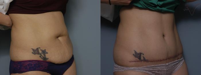 Before & After Tummy Tuck Case 215 Right Oblique View in Los Angeles, CA