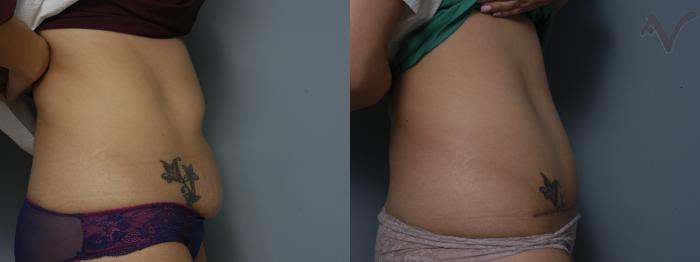Before & After Tummy Tuck Case 215 Right Side View in Los Angeles, CA