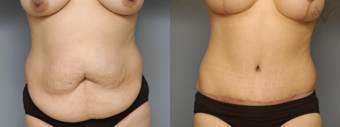Before & After Tummy Tuck Case 216 Front View in Los Angeles, CA