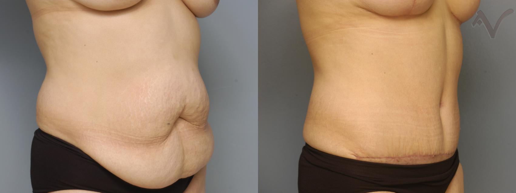 Before & After Tummy Tuck Case 216 Right Oblique View in Los Angeles, CA