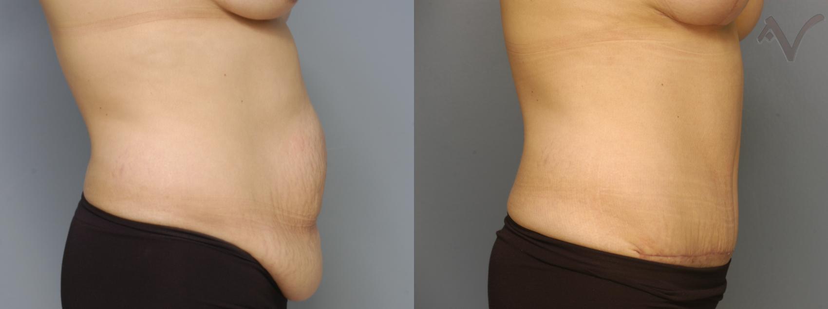 Before & After Tummy Tuck Case 216 Right Side View in Los Angeles, CA