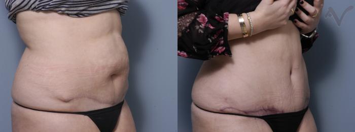 Before & After Tummy Tuck Case 218 Right Oblique View in Los Angeles, CA