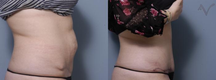 Before & After Tummy Tuck Case 218 Right Side View in Los Angeles, CA