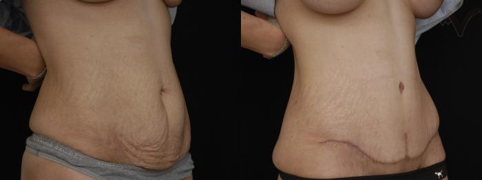 Before & After Tummy Tuck Case 236 Right Oblique View in Los Angeles, CA