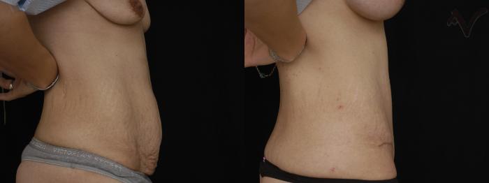 Before & After Tummy Tuck Case 236 Right Side View in Los Angeles, CA