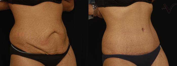 Before & After Tummy Tuck Case 237 Right Oblique View in Los Angeles, CA