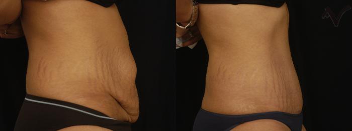 Before & After Tummy Tuck Case 237 Right Side View in Los Angeles, CA