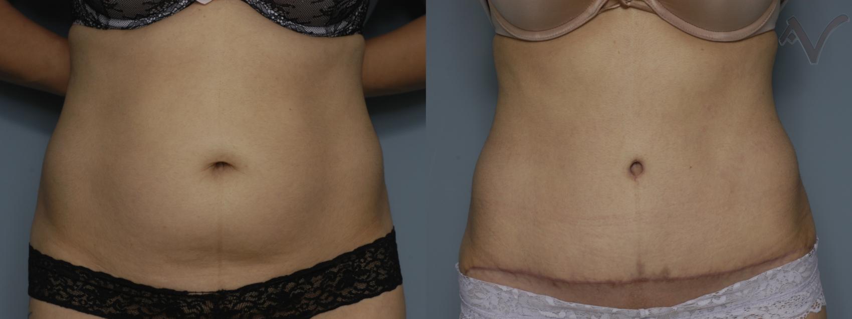 Before & After Tummy Tuck Case 238 Front View in Los Angeles, CA