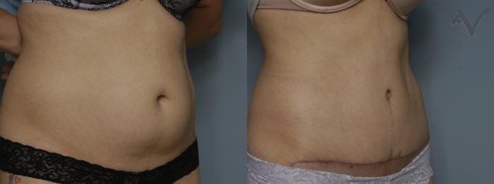 Before & After Tummy Tuck Case 238 Right Oblique View in Los Angeles, CA