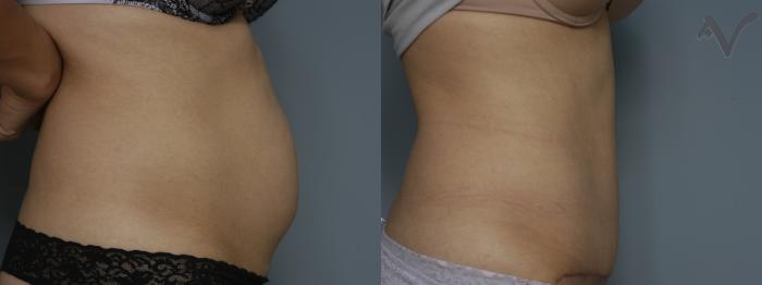 Before & After Tummy Tuck Case 238 Right Side View in Los Angeles, CA