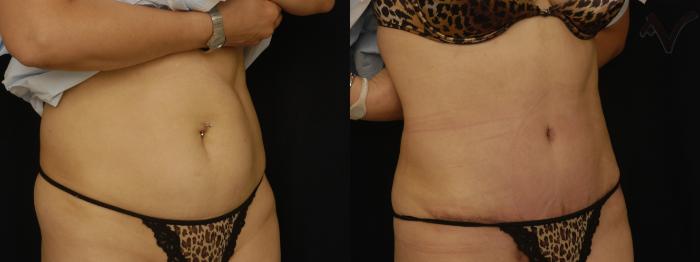 Before & After Tummy Tuck Case 239 Right Oblique View in Los Angeles, CA