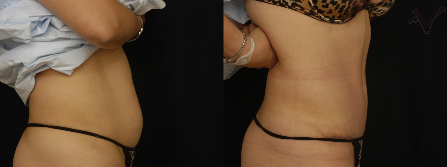 Before & After Tummy Tuck Case 239 Right Side View in Los Angeles, CA