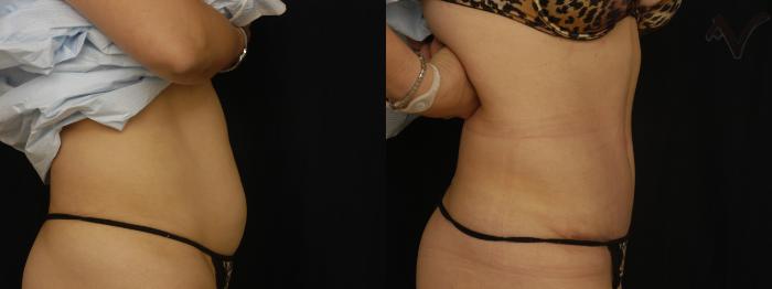 Before & After Tummy Tuck Case 239 Right Side View in Los Angeles, CA