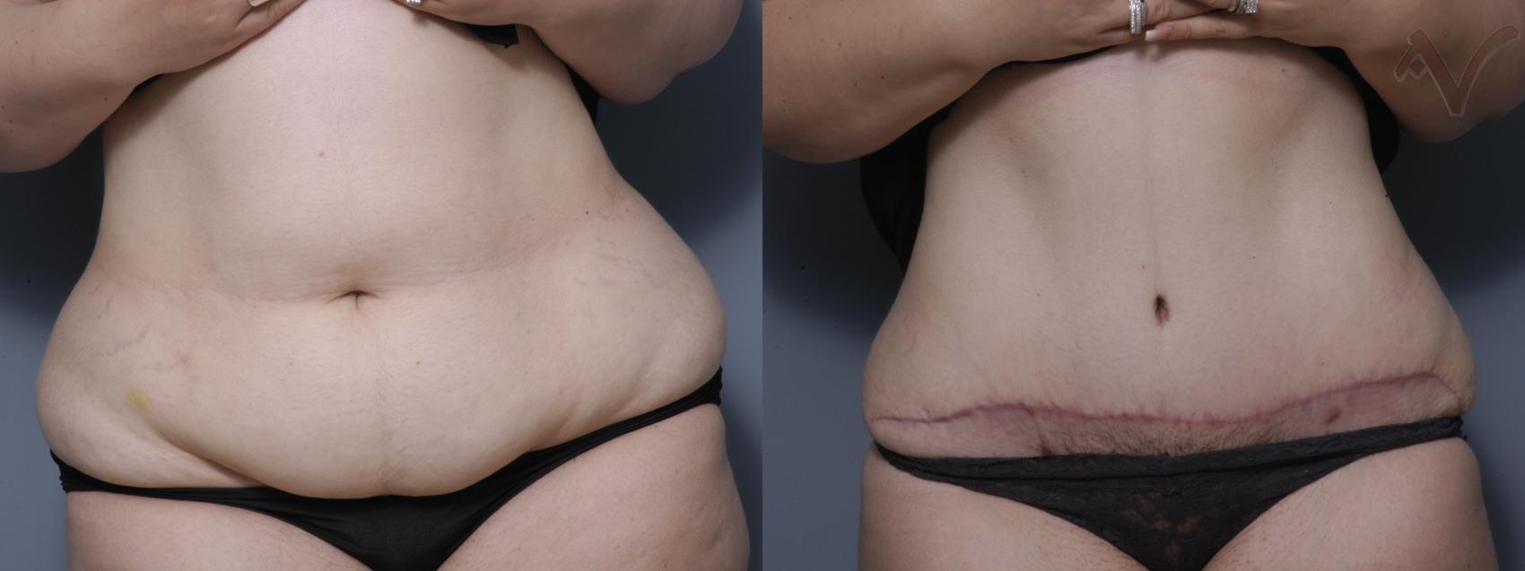 Before & After Tummy Tuck Case 241 Front View in Los Angeles, CA