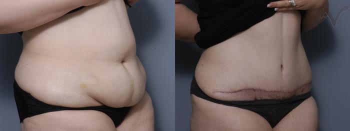 Before & After Tummy Tuck Case 241 Right Oblique View in Los Angeles, CA