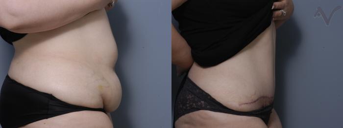 Before & After Tummy Tuck Case 241 Right Side View in Los Angeles, CA