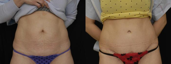 Before & After Tummy Tuck Case 242 Front View in Los Angeles, CA