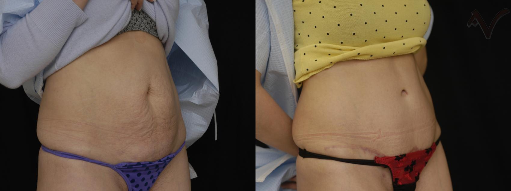 Before & After Tummy Tuck Case 242 Right Oblique View in Los Angeles, CA