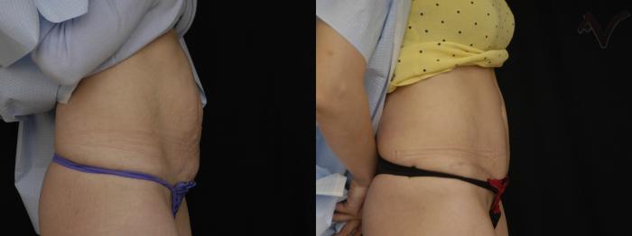 Before & After Tummy Tuck Case 242 Right Side View in Los Angeles, CA