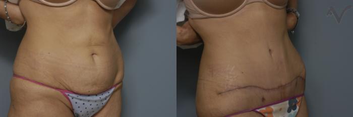 Before & After Tummy Tuck Case 245 Right Oblique View in Los Angeles, CA