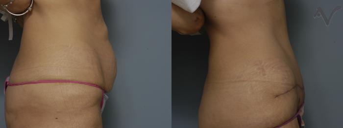 Before & After Tummy Tuck Case 245 Right Side View in Los Angeles, CA