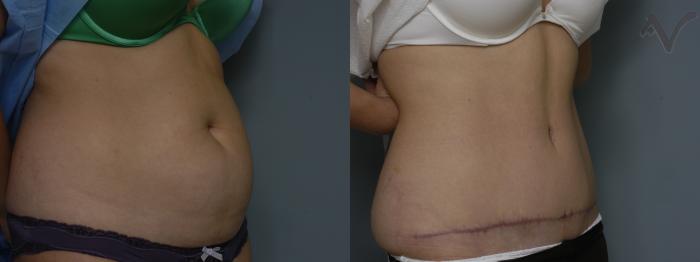 Before & After Tummy Tuck Case 247 Right Oblique View in Los Angeles, CA
