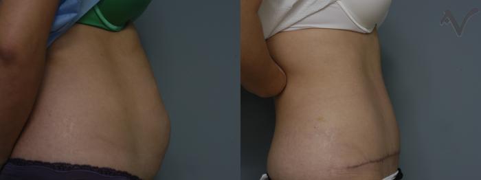 Before & After Tummy Tuck Case 247 Right Side View in Los Angeles, CA