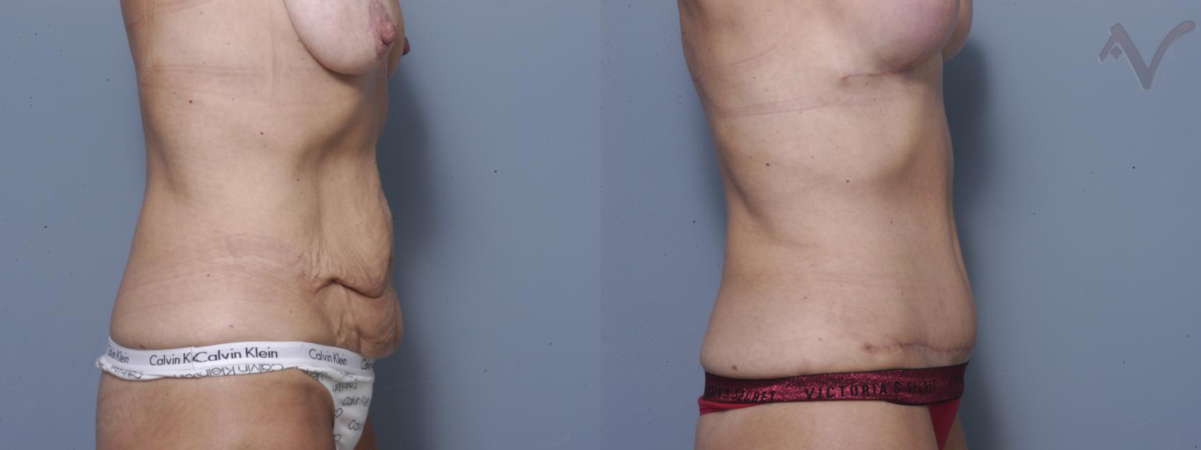 Before & After Tummy Tuck Case 249 Right Side View in Los Angeles, CA
