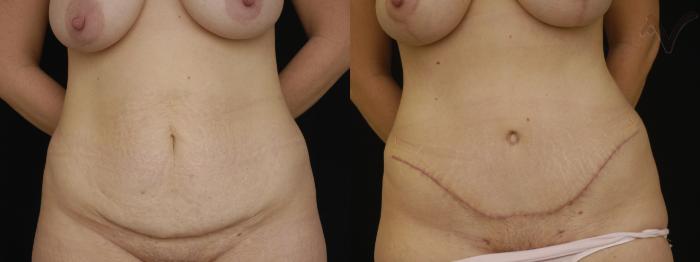 Before & After Tummy Tuck Case 265 Front View in Los Angeles, CA