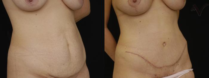 Before & After Tummy Tuck Case 265 Right Oblique View in Los Angeles, CA