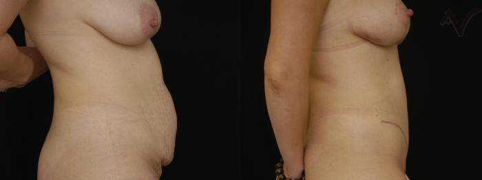 Before & After Tummy Tuck Case 265 Right Side View in Los Angeles, CA