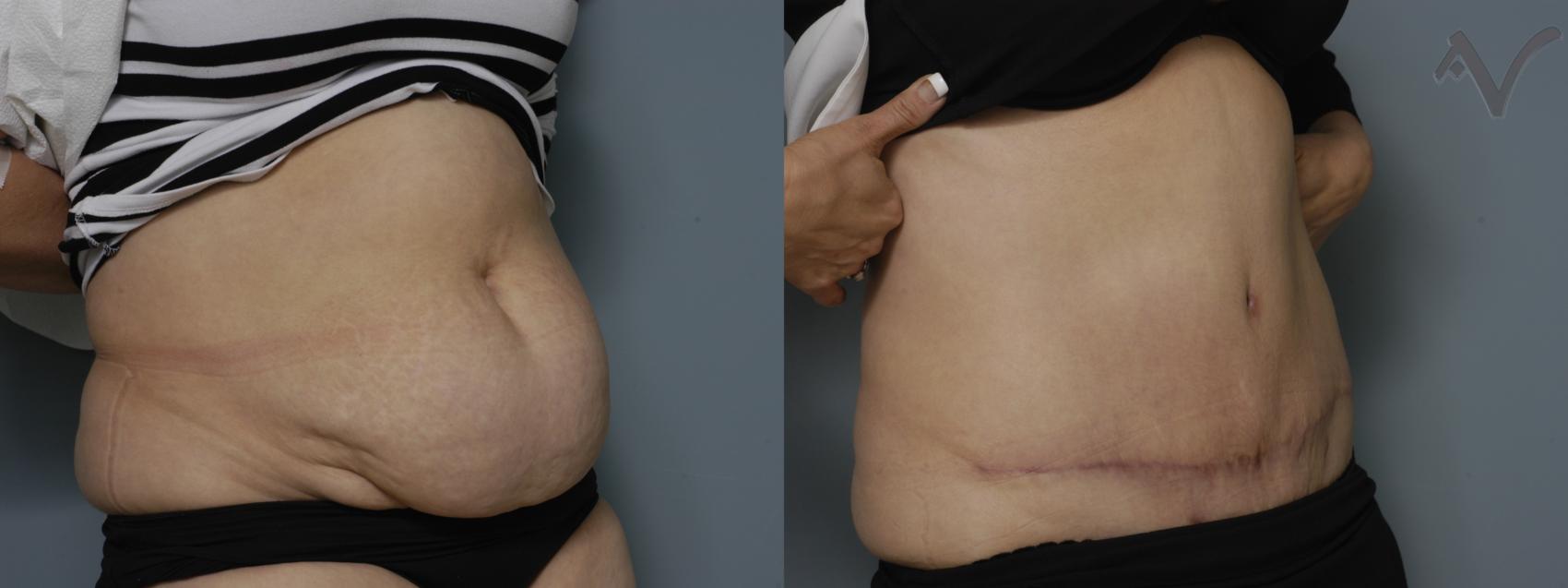 Before & After Tummy Tuck Case 267 Right Oblique View in Los Angeles, CA