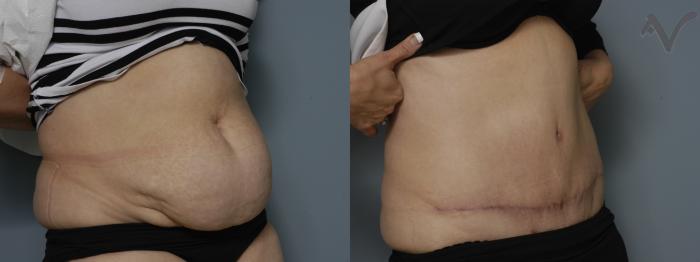Before & After Tummy Tuck Case 267 Right Oblique View in Los Angeles, CA