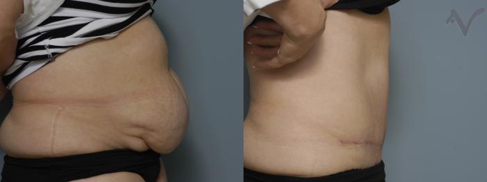 Before & After Tummy Tuck Case 267 Right Side View in Los Angeles, CA