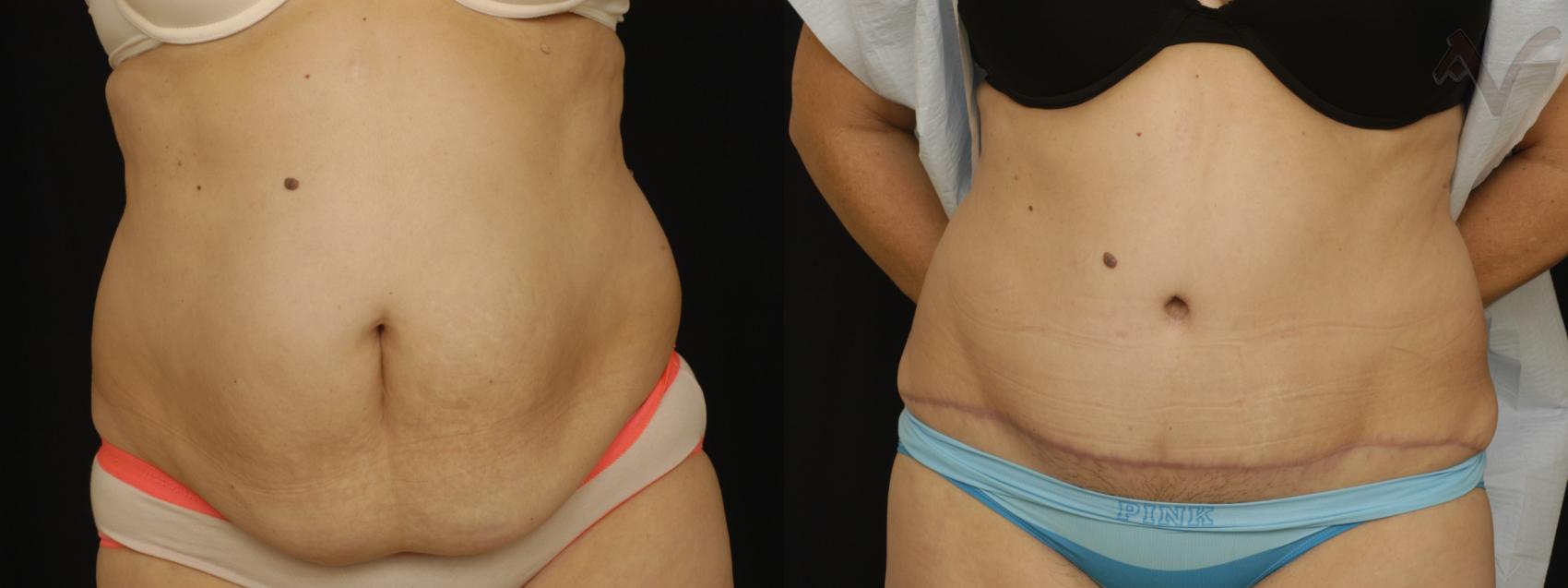 Before & After Tummy Tuck Case 268 Front View in Los Angeles, CA