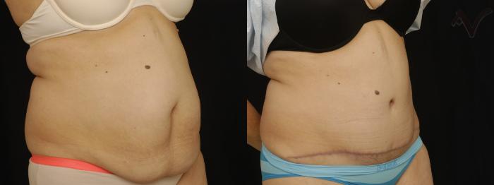 Before & After Tummy Tuck Case 268 Right Oblique View in Los Angeles, CA