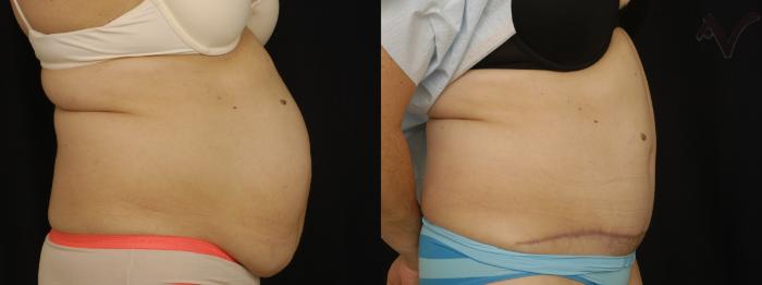 Before & After Tummy Tuck Case 268 Right Side View in Los Angeles, CA