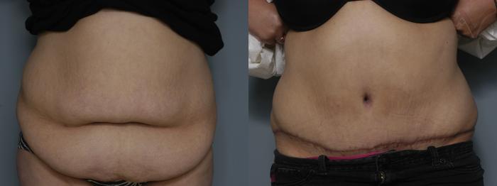 Before & After Tummy Tuck Case 270 Front View in Los Angeles, CA