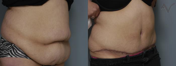 Before & After Tummy Tuck Case 270 Right Oblique View in Los Angeles, CA