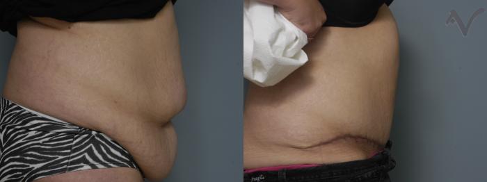 Before & After Tummy Tuck Case 270 Right Side View in Los Angeles, CA
