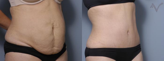 Before & After Tummy Tuck Case 271 Right Oblique View in Los Angeles, CA