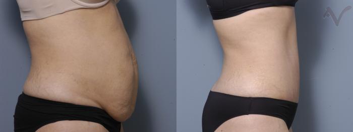 Before & After Tummy Tuck Case 271 Right Side View in Los Angeles, CA