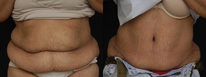 Before & After Tummy Tuck Case 273 Front View in Los Angeles, CA