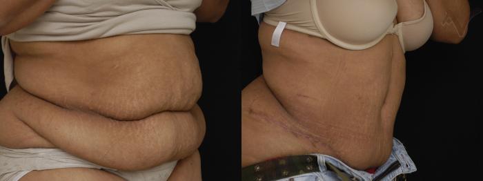 Before & After Tummy Tuck Case 273 Right Oblique View in Los Angeles, CA