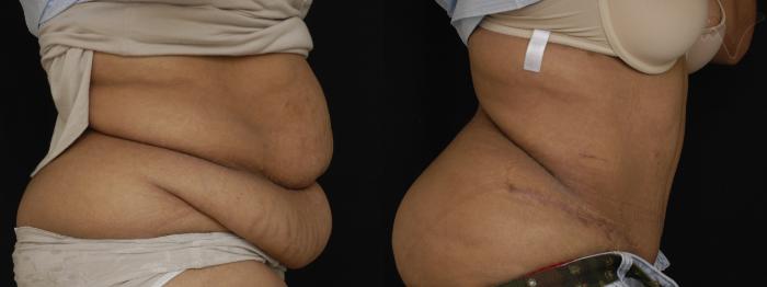 Before & After Tummy Tuck Case 273 Right Side View in Los Angeles, CA